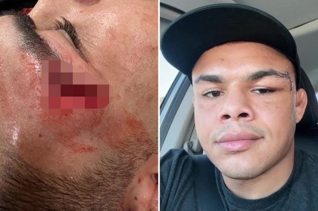 UFC Fighter Nikolas Motta Suffers Gruesome Head Cut Exposing Facial Tendon, Forcing Withdrawal from UFC 287